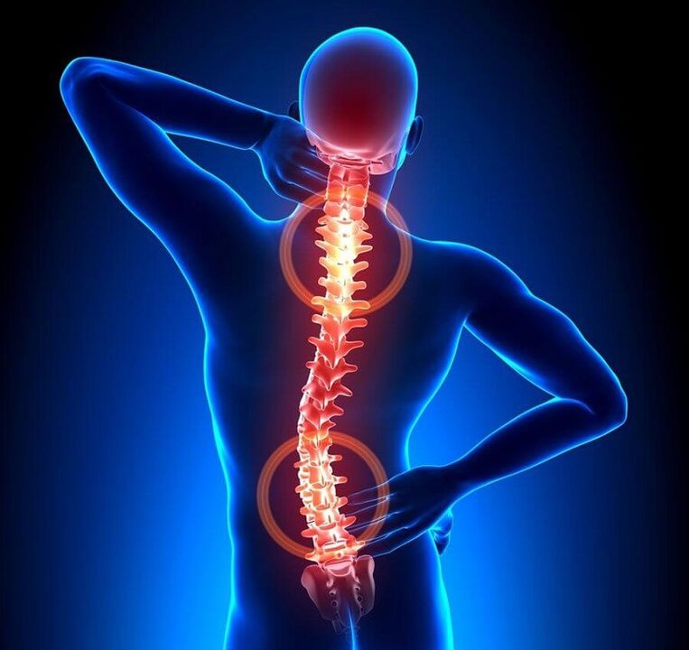 thoái hóa xương cột sống là nguyên nhân gây ra đau lưng