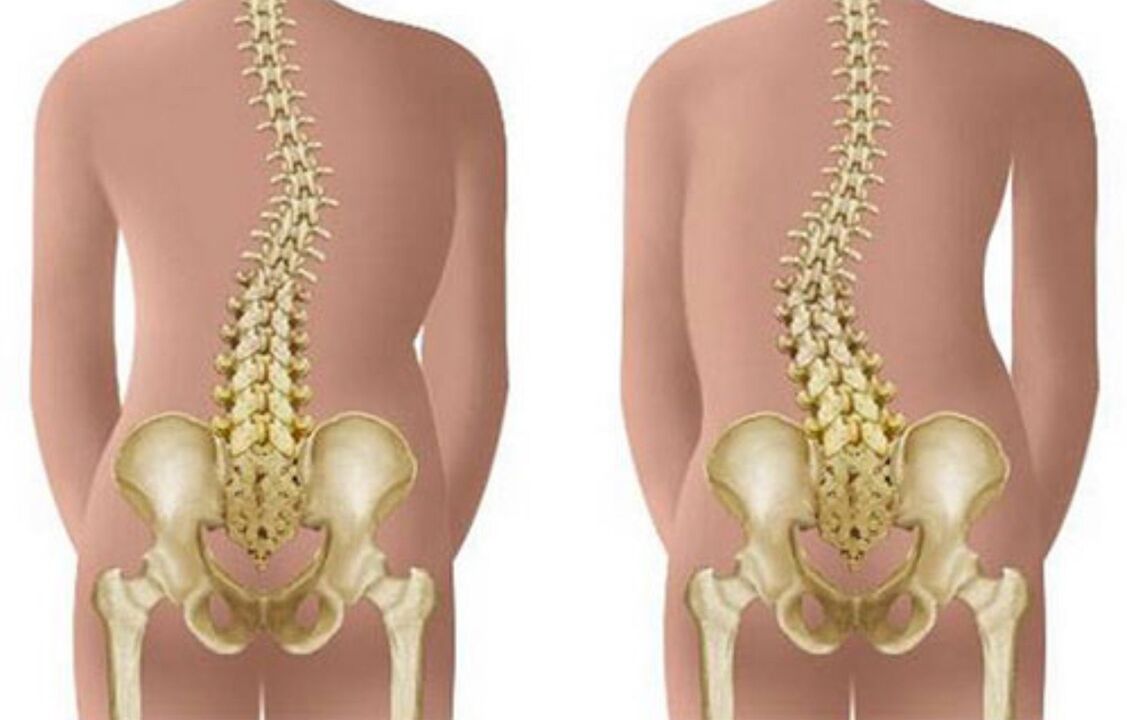 vẹo cột sống là nguyên nhân gây đau lưng ở vùng bả vai