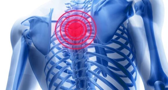 Điều trị bệnh xương khớp của cột sống ngực