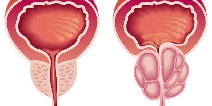 viêm tuyến tiền liệt
