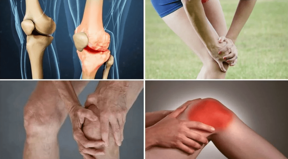 Các triệu chứng của bệnh viêm khớp