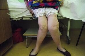 viêm khớp tiến triển của khớp gối